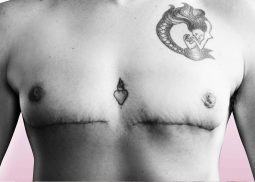 trans mastectomy