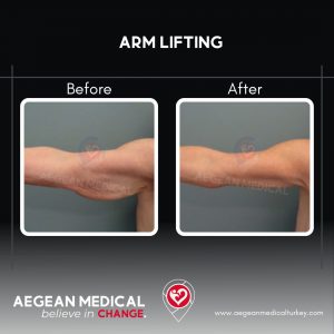 Arm Lift-1