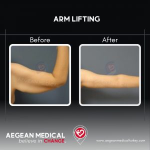 Arm Lift-2