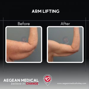 Arm Lift-3