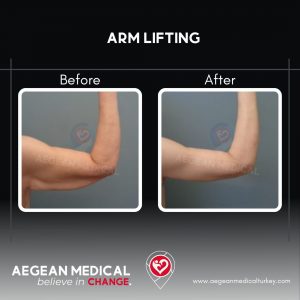 Arm Lift-4