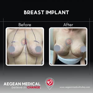 Breast Augmentation-1