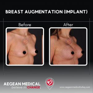 Breast Augmentation-2