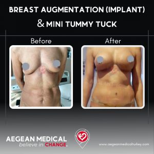 Breast Augmentation-4