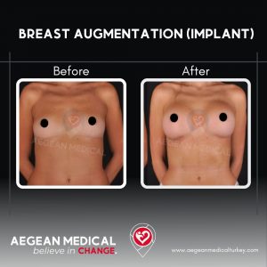 Breast Augmentation-5