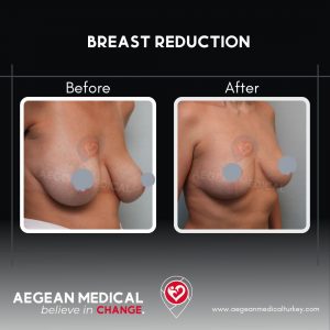 Breast Reduction-1