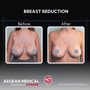 Breast Reduction-2