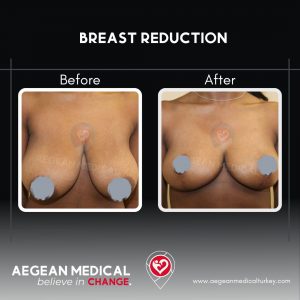 Breast Reduction-3