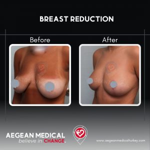 Breast Reduction-4