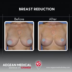 Breast Reduction-5