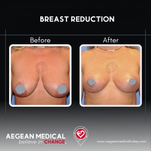 Breast Reduction-6