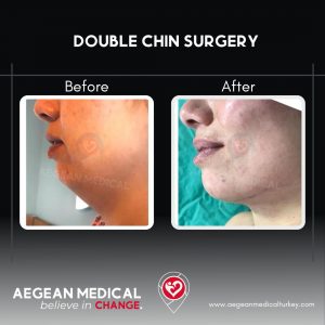 Double Chin Surgery