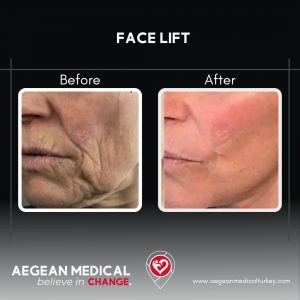 Face Lift-1