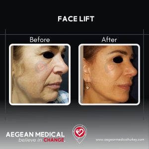 Face Lift-2