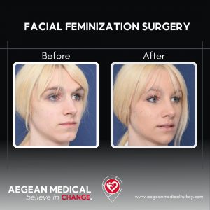 Facial Feminization-1