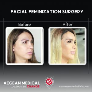 Facial Feminization-2