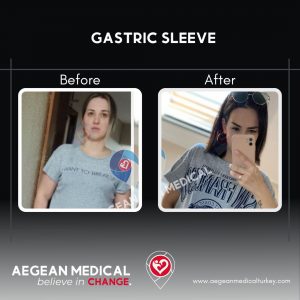 Gastric Sleeve-7