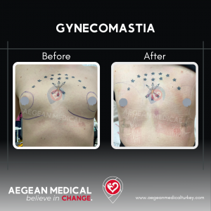 Gynecomastia-1