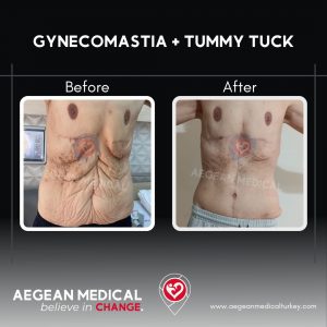 Gynecomastia-2