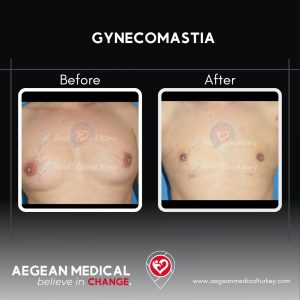 Gynecomastia-3