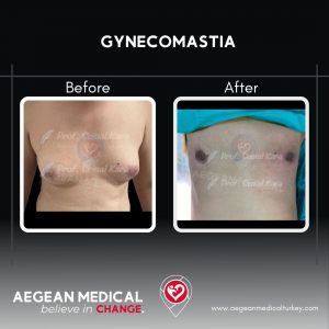 Gynecomastia-4