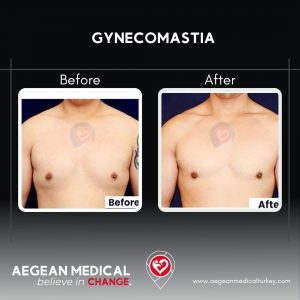 Gynecomastia-5