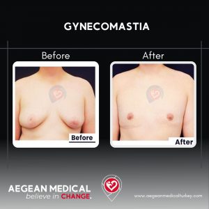 Gynecomastia-6