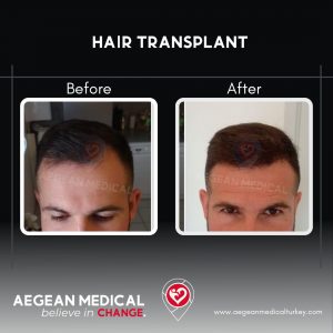 Hair Transplant-1