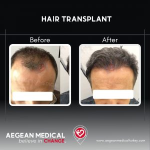 Hair Transplant-2