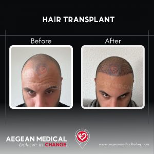 Hair Transplant-3