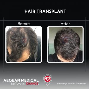 Hair Transplant-4