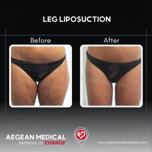 Leg Lipo-1