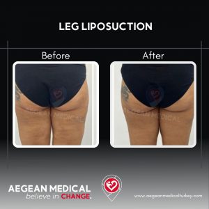 Leg Lipo-2