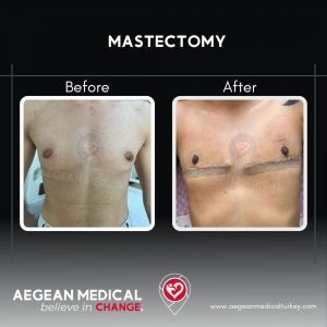 Mastectomy-1