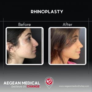 Rhinoplasty-1