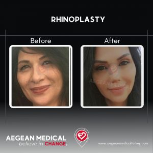 Rhinoplasty-2