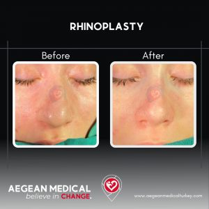 Rhinoplasty-3