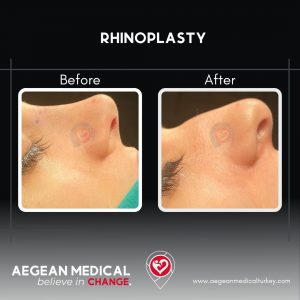 Rhinoplasty-4