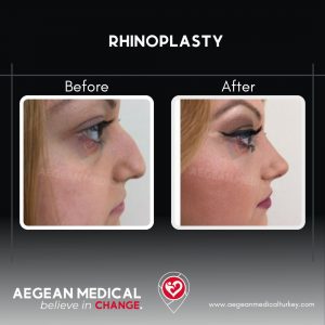 Rhinoplasty-5