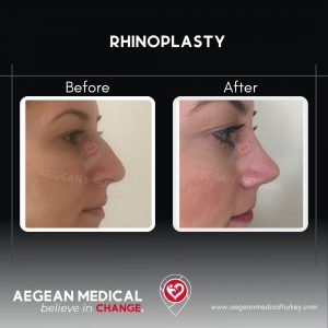 Rhinoplasty-6