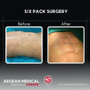 Six Pack Surgery-1