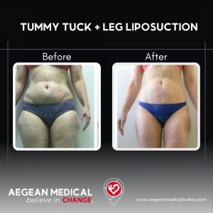 Tummy Tuck-1