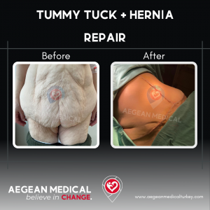 Tummy Tuck-3