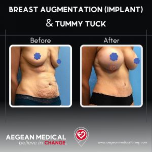 Tummy Tuck-4