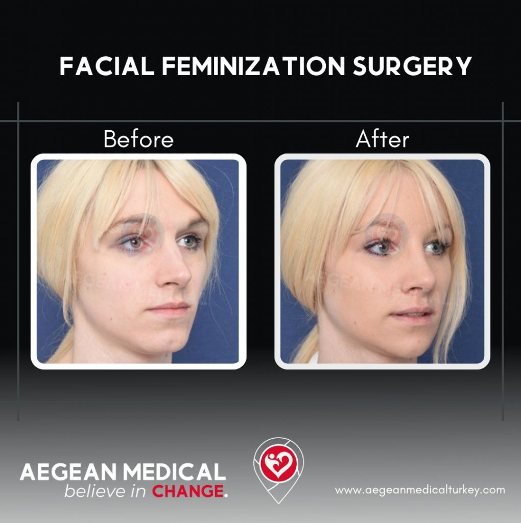 Facial Feminization 